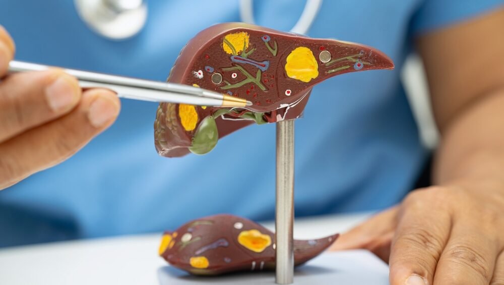 Which Ayurvedic Liver Tonic Syrup Works Best for Fatty Liver