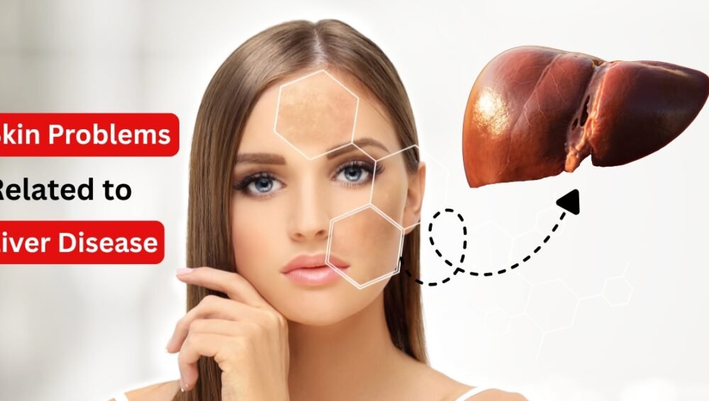 Skin Problems Related to Liver Disease