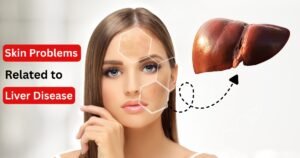 Skin Problems Related to Liver Disease